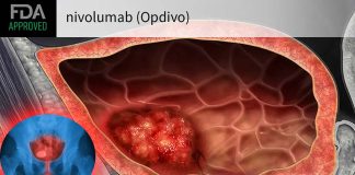 The immunotherapy nivolumab after surgery helped reduce cancer recurrence in patients with urothelial cancer of the bladder
