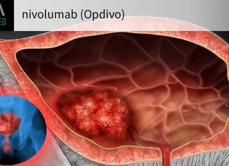 The immunotherapy nivolumab after surgery helped reduce cancer recurrence in patients with urothelial cancer of the bladder