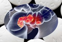 Cancro del colon-retto: l’aspirina riduce il tasso di divisione cellulare del tumore e aumenta il tasso di morte cellulare
