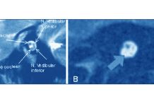 Hidden hearing loss in human ears