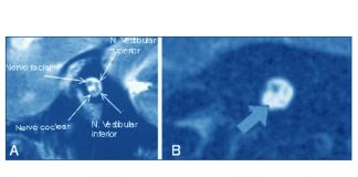 Hidden hearing loss in human ears