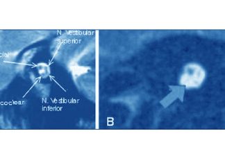 Hidden hearing loss in human ears
