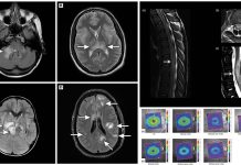 SARS-COV-2 Can Causes Myelin Oligodendrocyte Glycoprotein-Associated Disorder (MOGAD)