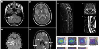 SARS-COV-2 Can Causes Myelin Oligodendrocyte Glycoprotein-Associated Disorder (MOGAD)