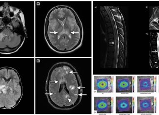SARS-COV-2 Can Causes Myelin Oligodendrocyte Glycoprotein-Associated Disorder (MOGAD)