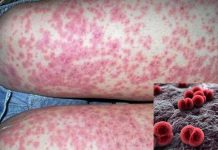 Meningococcal Disease Outbreak: Gay and bisexual men urged to get vaccinated if living in Florida