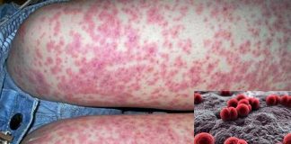 Meningococcal Disease Outbreak: Gay and bisexual men urged to get vaccinated if living in Florida