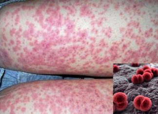 Meningococcal Disease Outbreak: Gay and bisexual men urged to get vaccinated if living in Florida