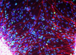 Motor neurone degenerative diseases are caused by abnormal lipid processing pathways inside brain cells
