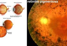 Retinite pigmentosa: nuovo trattamento – Il ripristino della cerniera molecolare previene la morte cellulare