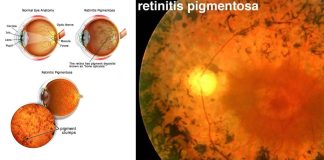 Retinite pigmentosa: nuovo trattamento – Il ripristino della cerniera molecolare previene la morte cellulare