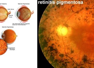Retinite pigmentosa: nuovo trattamento – Il ripristino della cerniera molecolare previene la morte cellulare