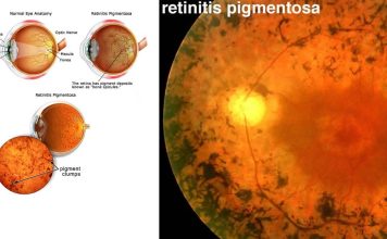 Retinite pigmentosa: nuovo trattamento – Il ripristino della cerniera molecolare previene la morte cellulare