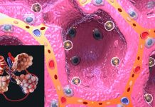 I lunghi sintomi debilitanti del COVID sono correlati ad anomalie microscopiche che influenzano il modo in cui l’ossigeno viene scambiato dai polmoni ai globuli rossi