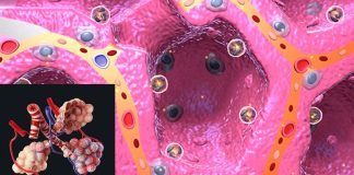 I lunghi sintomi debilitanti del COVID sono correlati ad anomalie microscopiche che influenzano il modo in cui l’ossigeno viene scambiato dai polmoni ai globuli rossi