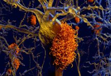 Alzheimer’s disease: researchers succeeded in producing dopaminergic A9 neurons from human-induced pluripotent stem cells