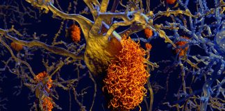 Alzheimer’s disease: researchers succeeded in producing dopaminergic A9 neurons from human-induced pluripotent stem cells