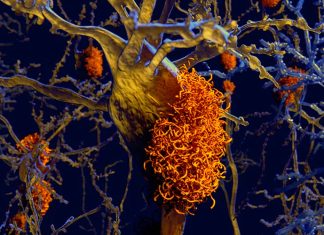 Alzheimer’s disease: researchers succeeded in producing dopaminergic A9 neurons from human-induced pluripotent stem cells
