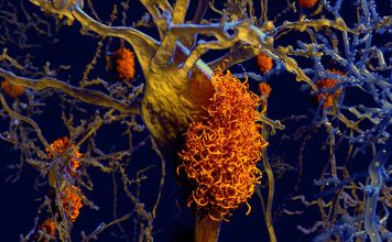 Alzheimer’s disease: researchers succeeded in producing dopaminergic A9 neurons from human-induced pluripotent stem cells