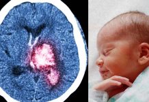 Babies who experience severe brain bleeds during their first year of life are more likely to have long-term visual problems