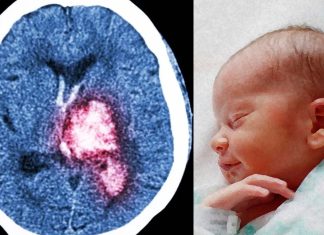 Babies who experience severe brain bleeds during their first year of life are more likely to have long-term visual problems