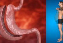 Obesità: la chirurgia bariatrica riduce il rischio di sviluppare il cancro