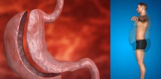 Obesità: la chirurgia bariatrica riduce il rischio di sviluppare il cancro