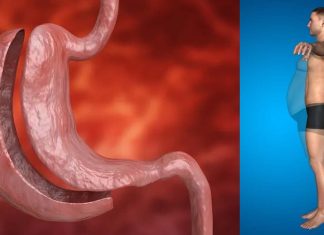 Obesità: la chirurgia bariatrica riduce il rischio di sviluppare il cancro