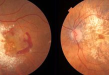 The AREDS2 dietary supplement reduces the risk of age-related macular degeneration progression