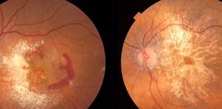 The AREDS2 dietary supplement reduces the risk of age-related macular degeneration progression