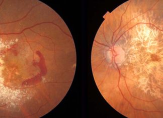 The AREDS2 dietary supplement reduces the risk of age-related macular degeneration progression