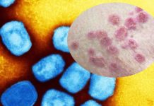 WHO is considering whether to declare Monkeypox a new epidemic