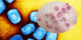 WHO is considering whether to declare Monkeypox a new epidemic