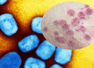 WHO is considering whether to declare Monkeypox a new epidemic