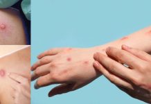 Monkeypox is ramping up all over the world – over 2100 cases