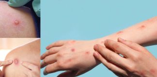Monkeypox is ramping up all over the world – over 2100 cases