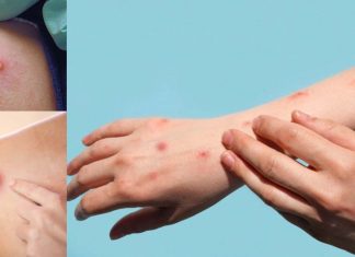 Monkeypox is ramping up all over the world – over 2100 cases