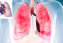 New treatment of severe pulmonary hypertension with umbilical cord stem cells