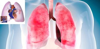 New treatment of severe pulmonary hypertension with umbilical cord stem cells
