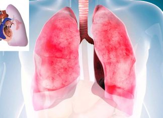 New treatment of severe pulmonary hypertension with umbilical cord stem cells