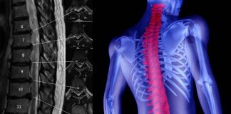 The NCX3 gene amplifies pain signals within the spinal cord
