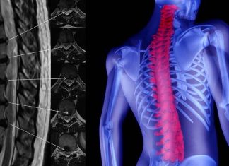 The NCX3 gene amplifies pain signals within the spinal cord