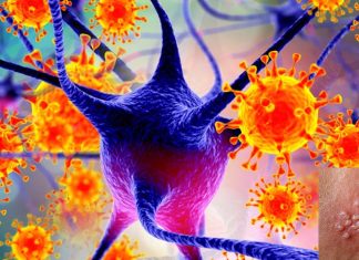 Varicella zoster virus (VZV) may be triggering the onset of Alzheimer’s disease