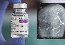 Ricercatori scandinavi hanno confermato che il vaccino COVID-19 di AstraZeneca aumenta l’incidenza di trombosi venosa cerebrale