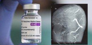 Scandinavian researchers Confirmed That AstraZeneca’s COVID-19 Jab Increases Incidences Of Cerebral Venous Thrombosis