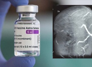 Ricercatori scandinavi hanno confermato che il vaccino COVID-19 di AstraZeneca aumenta l’incidenza di trombosi venosa cerebrale