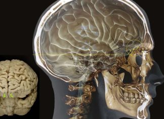 Rapid olfactory decline during aging predicts dementia – Alzheimer’s