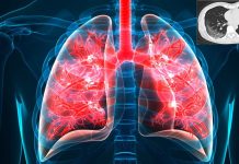 Covid-19: some patients will develop a fibrotic lung disease
