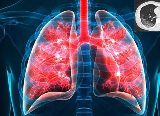 Covid-19: some patients will develop a fibrotic lung disease