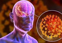 SARS-CoV-2 Infections Can Also Cause Long Term Peripheral Nerve Demyelination And Axonal Loss